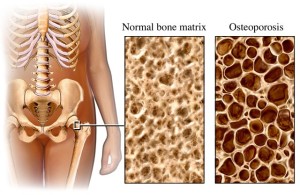 osteoporosi nel corpo umano